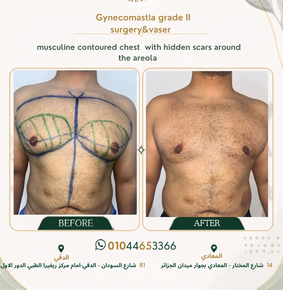 حالة تثدي رقم ١ — صورة قبل وبعد العلاج 1