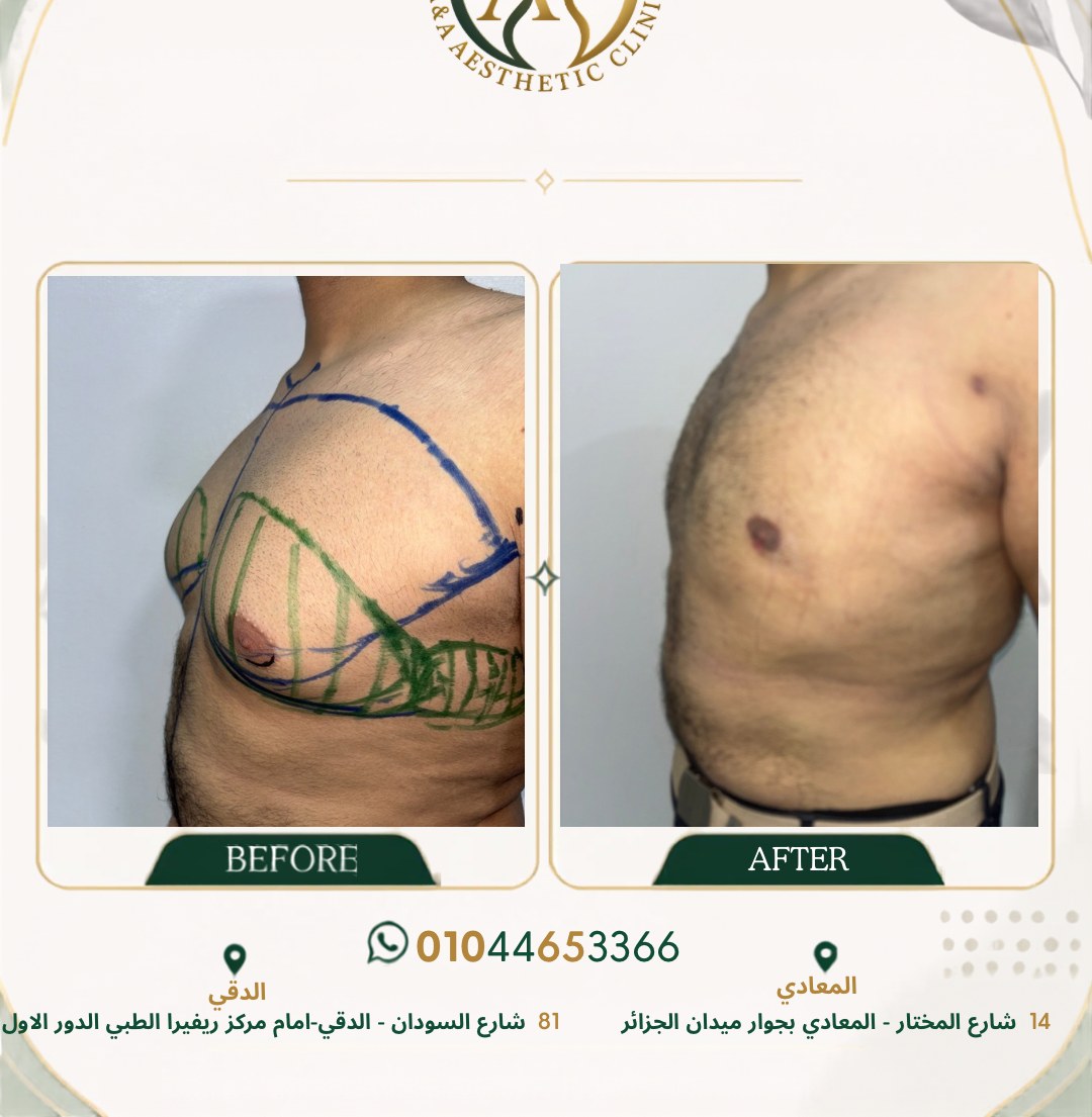 حالة تثدي رقم ٢ — صورة قبل وبعد العلاج 2
