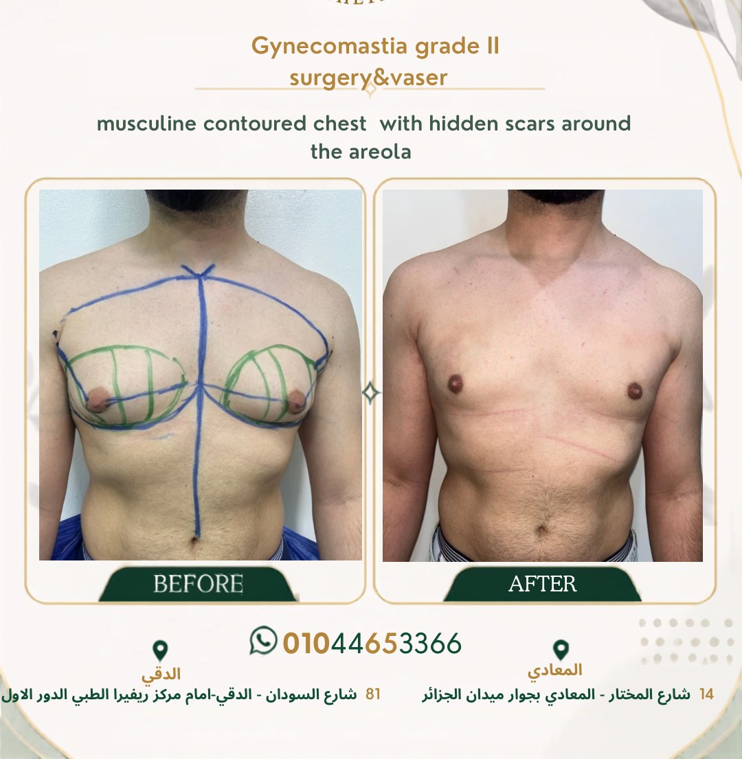 حالة تثدي رقم ٣ — صورة قبل وبعد العلاج 1