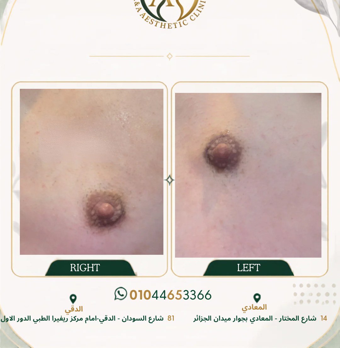 حالة تثدي رقم ٣ — صورة قبل وبعد العلاج 3