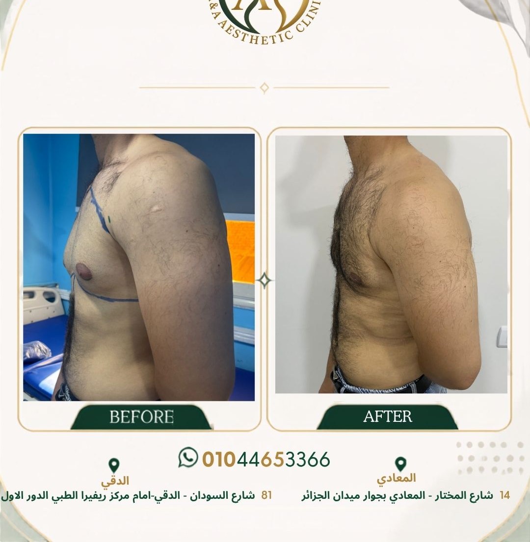 حالة تثدي رقم ٤ — صورة قبل وبعد العلاج 2