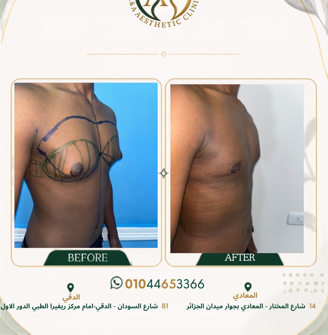 حالة تثدي رقم ٥ — صورة قبل وبعد العلاج 2