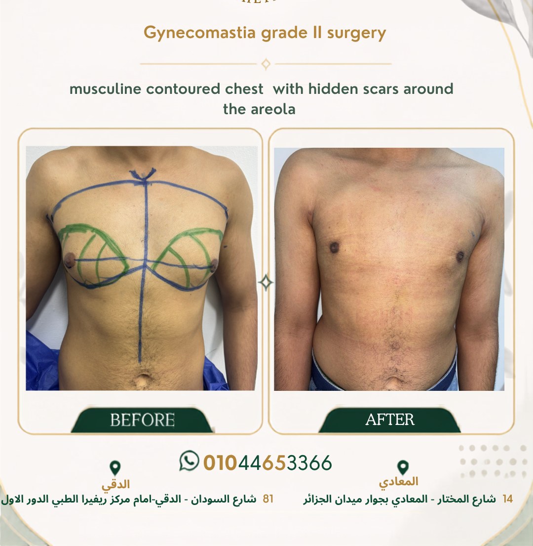 حالة تثدي رقم ٦ — صورة قبل وبعد العلاج 1