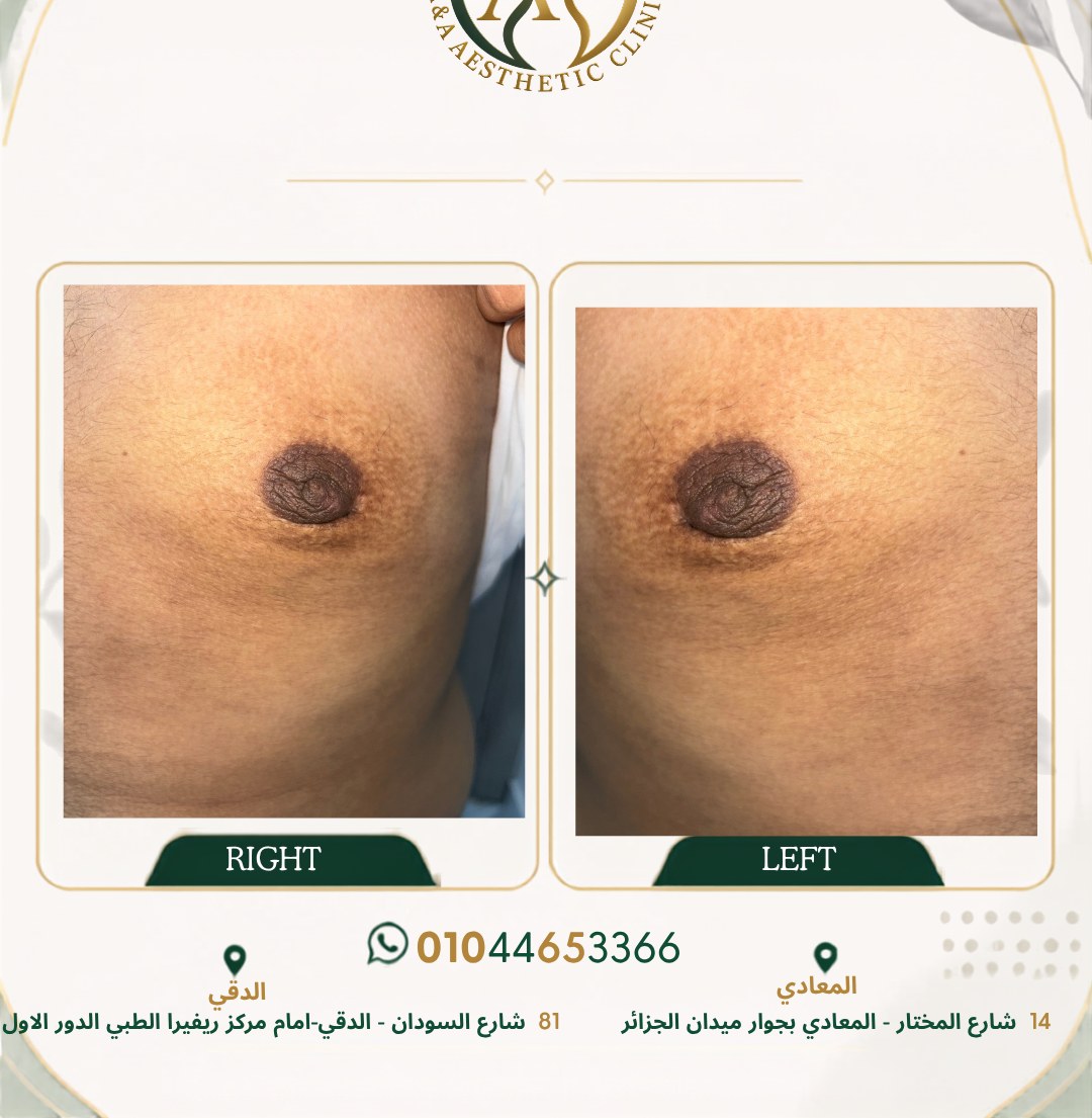 حالة تثدي رقم ٧ — صورة قبل وبعد العلاج 1